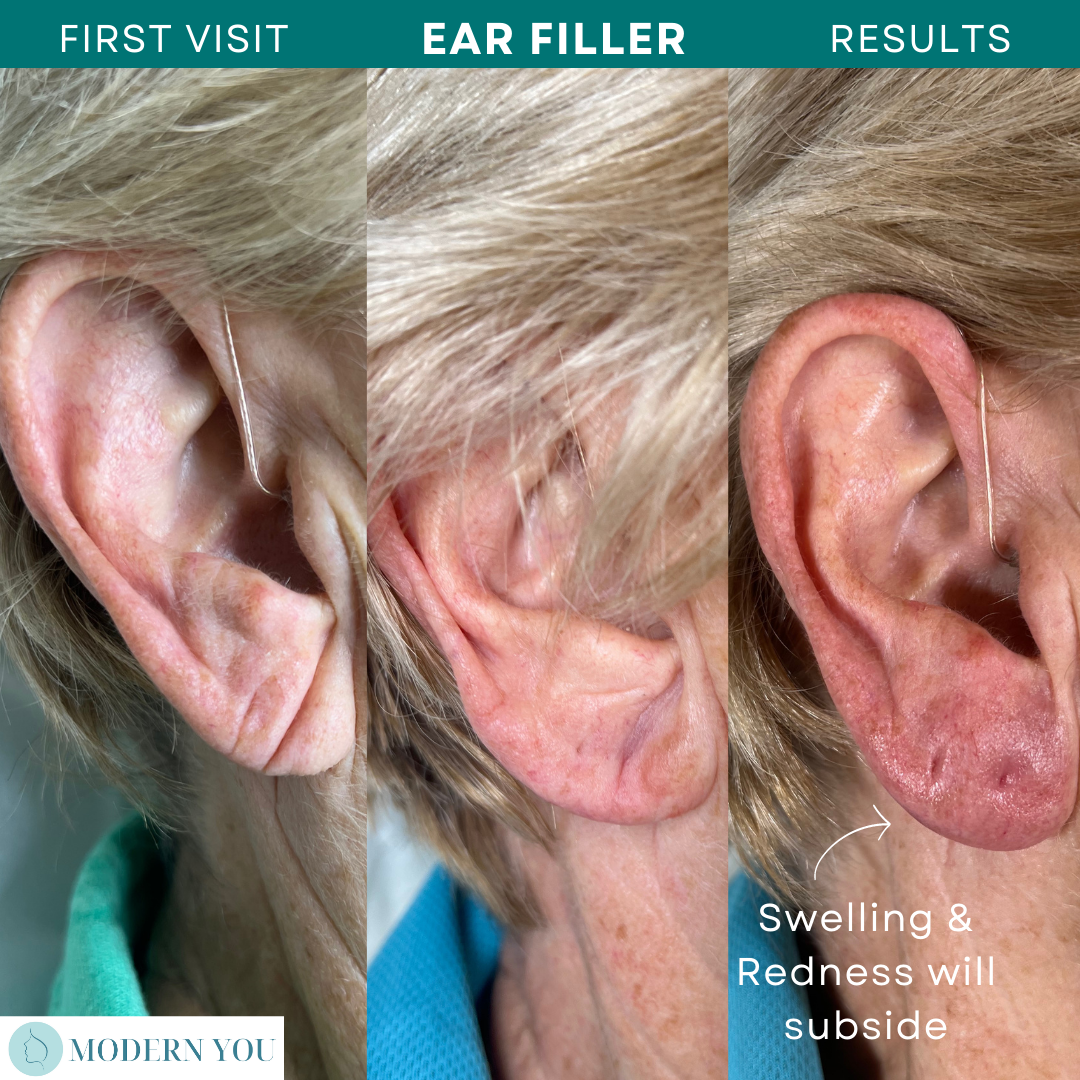 Side-by-side comparison of an ear before and after filler. Swelling and redness are visible after the procedure.