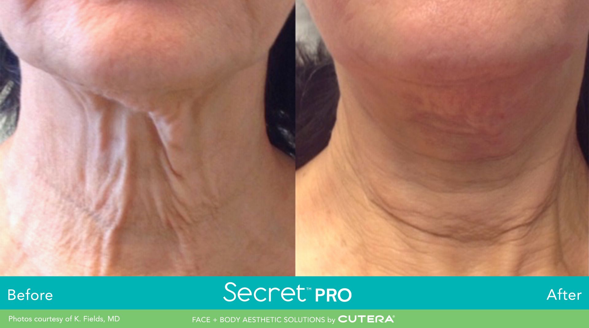 non surgical neck lift before and after