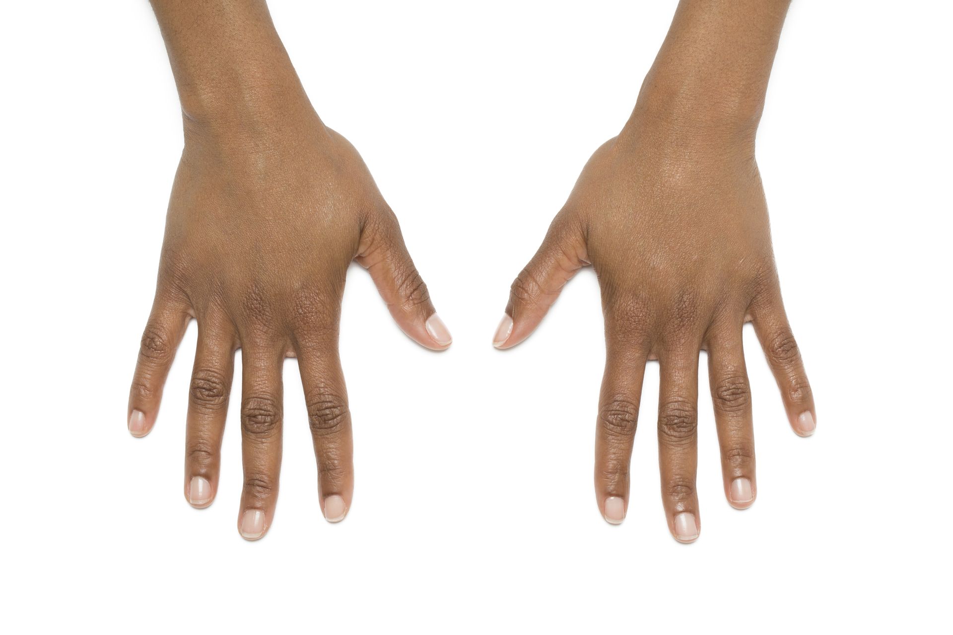 radiesse hands before and after
Dermal fillers Burlington
Facial fillers
Lip fillers Burlington
Under-eye fillers
Cheek fillers
Non-surgical nose job
Filler for fine lines
Best fillers for volume
Hyaluronic acid fillers
Filler injections Burlington
Anti-aging fillers
Sculptra treatment Burlington
Natural-looking fillers
Filler for wrinkles
Liquid facelift Burlington
Collagen-stimulating fillers
Radiesse treatment
Filler consultation Burlington
Non-invasive facial treatments
Aesthetic filler services