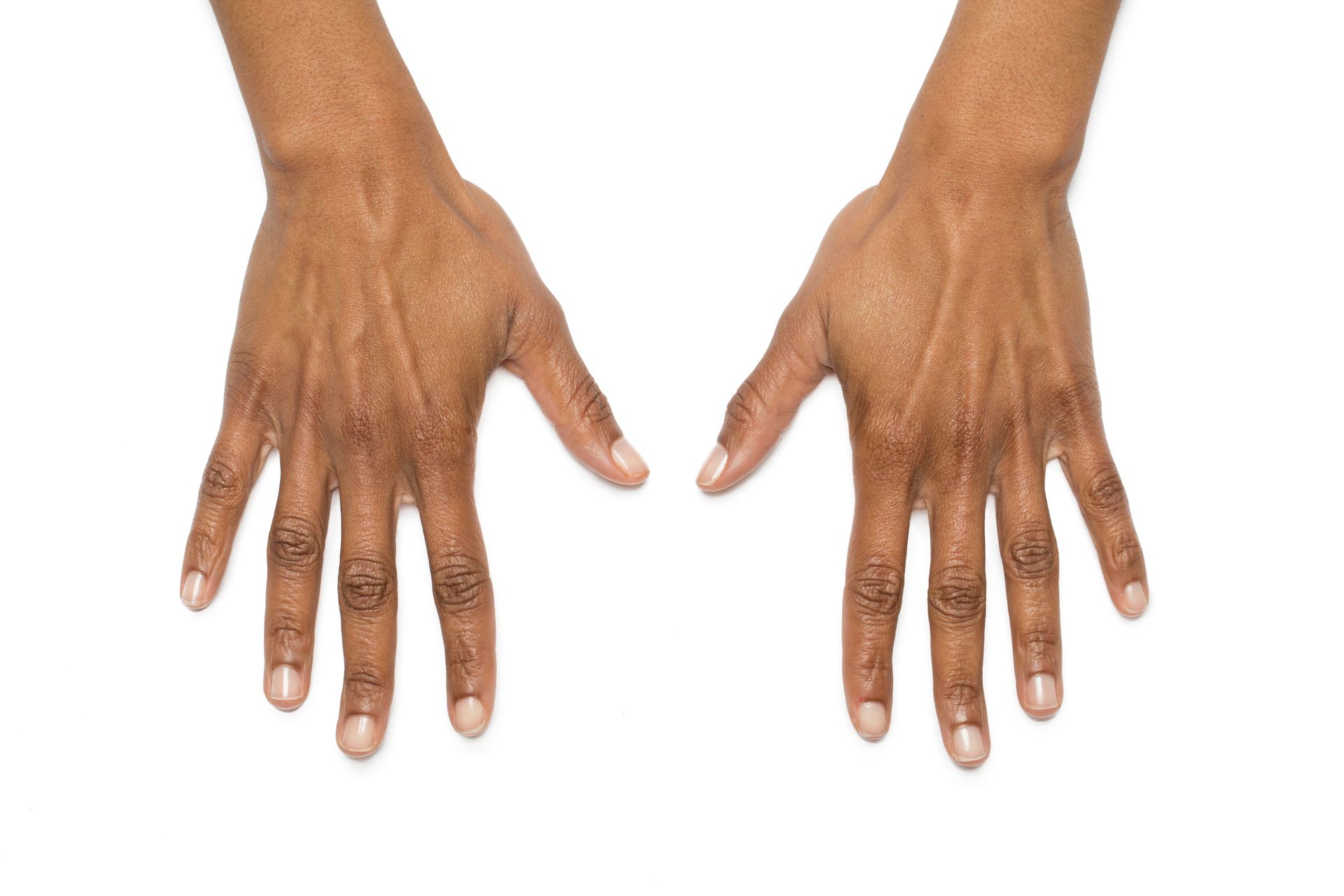 hand filler before and after burlington
Dermal fillers Burlington
Facial fillers
Lip fillers Burlington
Under-eye fillers
Cheek fillers
Non-surgical nose job
Filler for fine lines
Best fillers for volume
Hyaluronic acid fillers
Filler injections Burlington
Anti-aging fillers
Sculptra treatment Burlington
Natural-looking fillers
Filler for wrinkles
Liquid facelift Burlington
Collagen-stimulating fillers
Radiesse treatment
Filler consultation Burlington
Non-invasive facial treatments
Aesthetic filler services