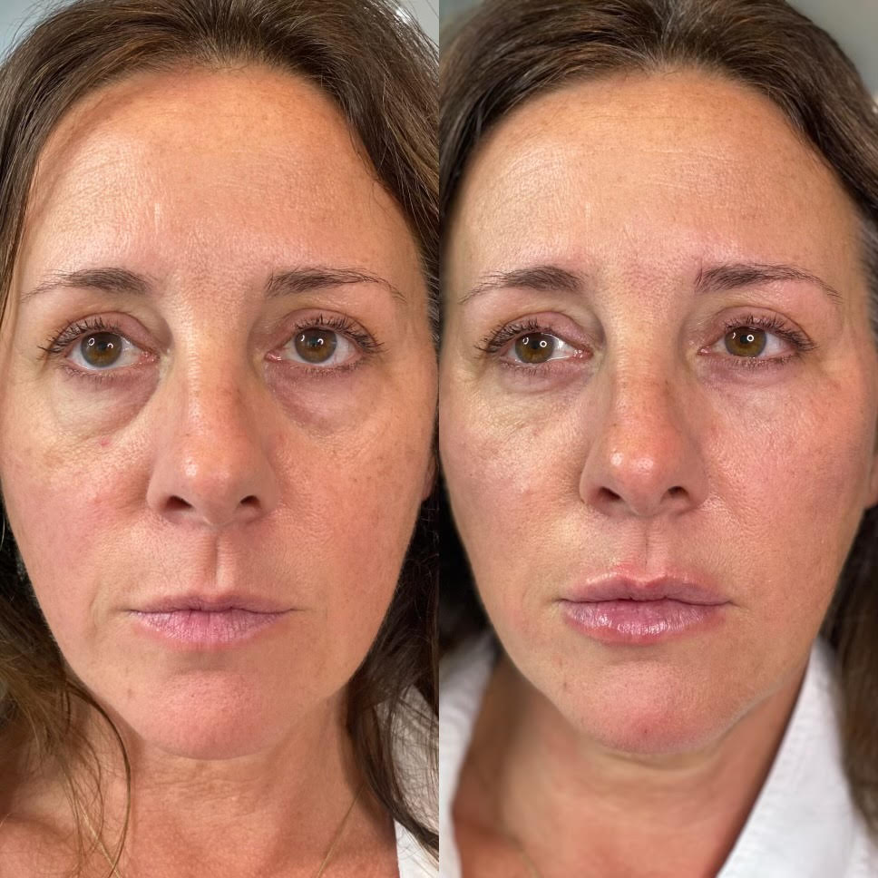 Before and after photos of a woman's face, showing reduction of dark circles and wrinkles.