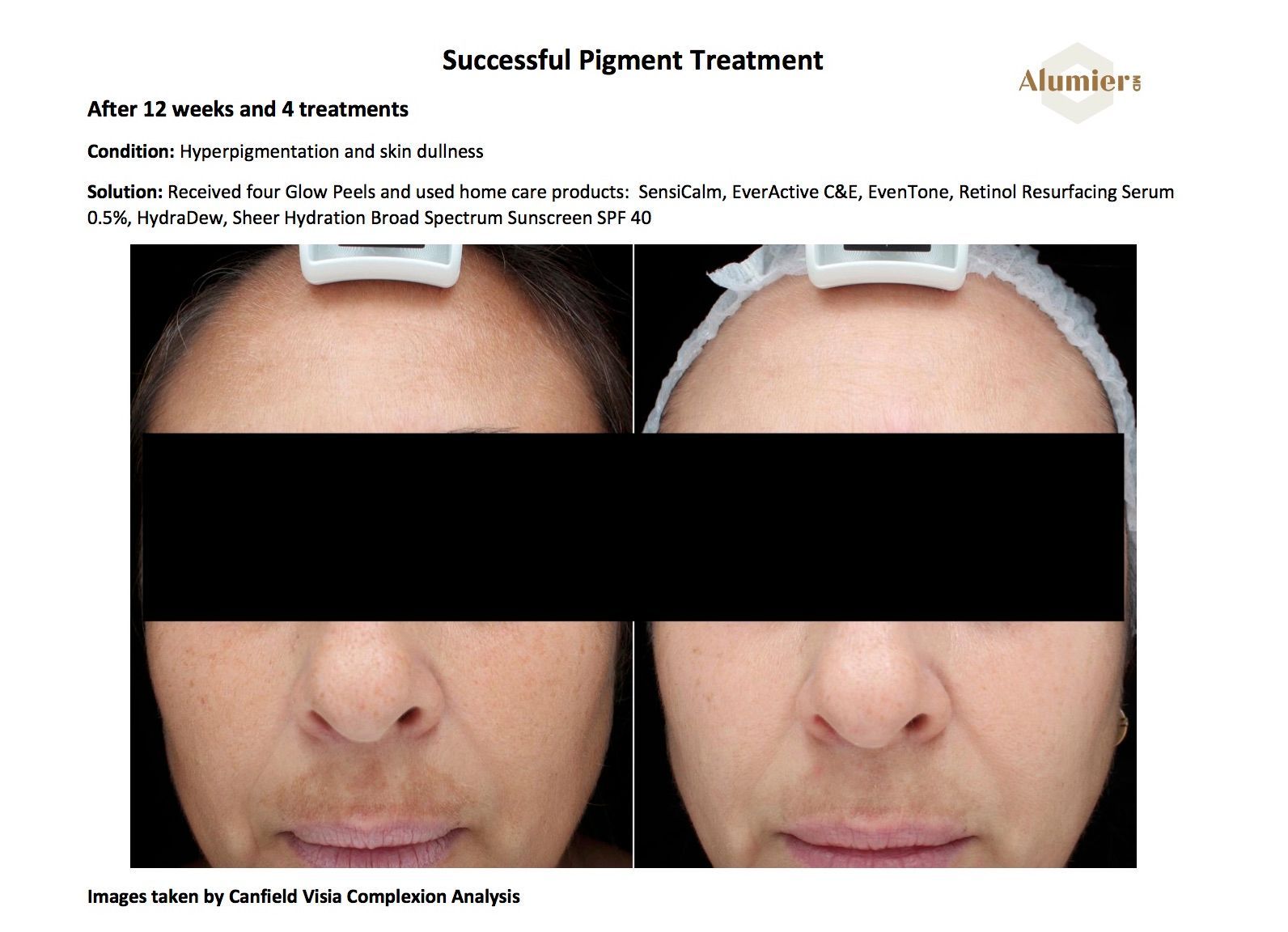 alumierMD chemical peel before and after for pigmentation
