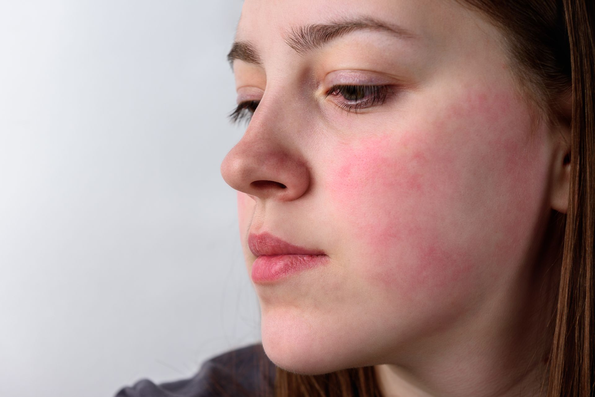A person viewed from the side, showing a prominent, reddish, flushed rash covering their cheek.