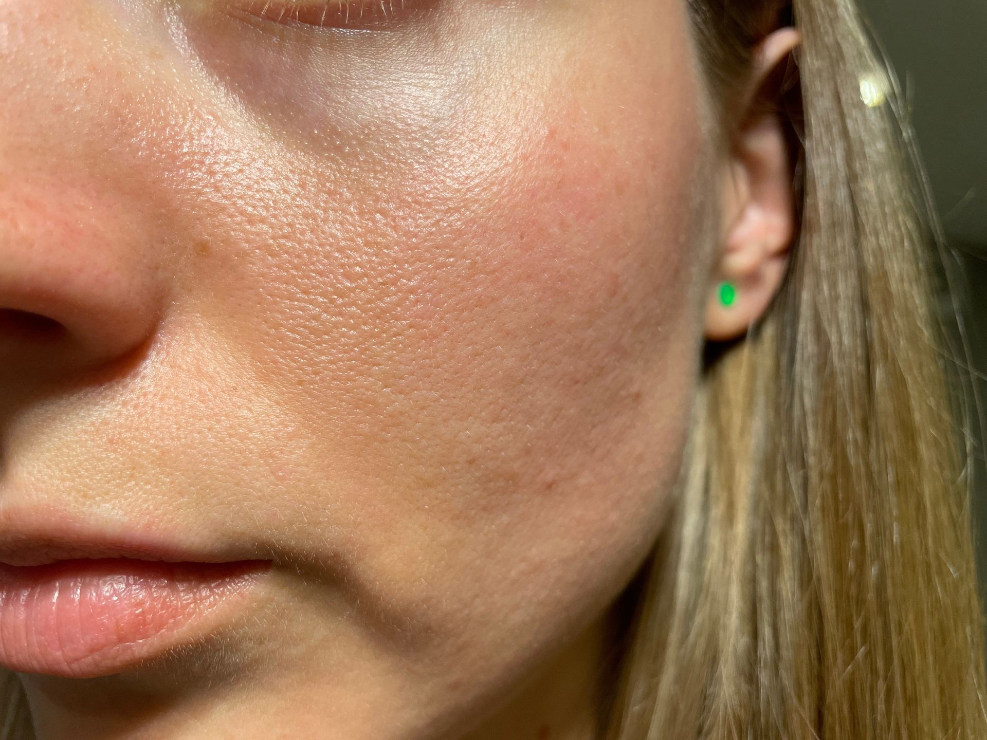 A close-up view of a person's cheek and under-eye area, showing skin texture and pores in warm lighting.