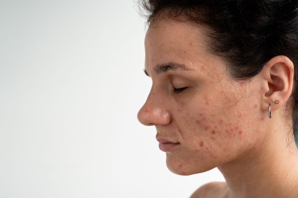A profile view of a person’s face against a white background, highlighting skin texture, redness, and acne breakouts.