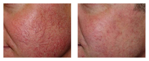 brown spot removal before and after