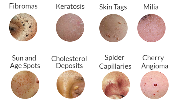 thermoclear in burlington, skin tag removal in burlington