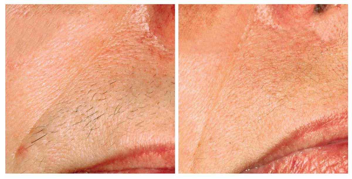laser hair removal before and after burlington