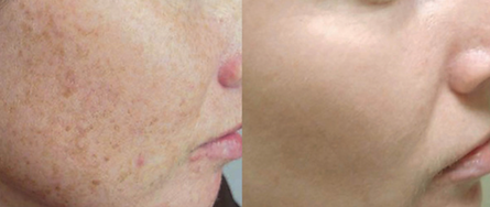 A woman 's face is shown before and after a treatment.