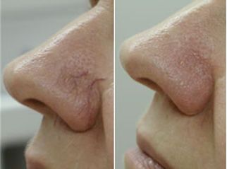 A before and after photo of a woman 's nose with veins.