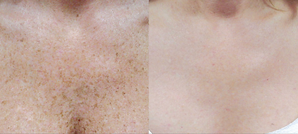 A before and after photo of a woman 's neck and chest.