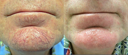 A before and after photo of a person 's face with veins on it.