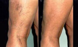 A before and after photo of a person 's legs with varicose veins.