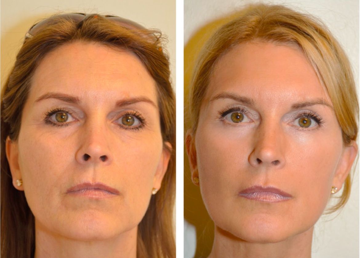 A before and after photo of a woman 's face.