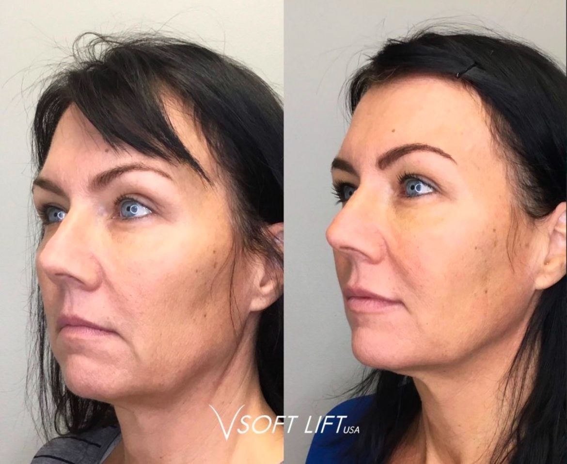 A before and after photo of a woman 's face.