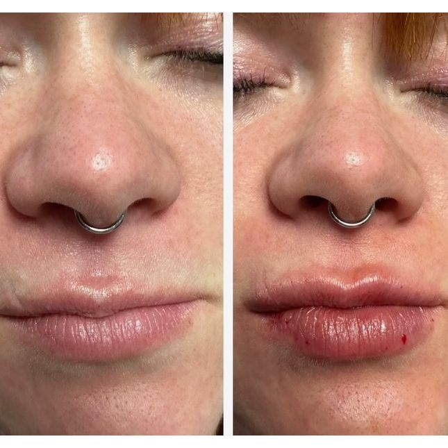 A before and after photo of a woman 's nose and lips.