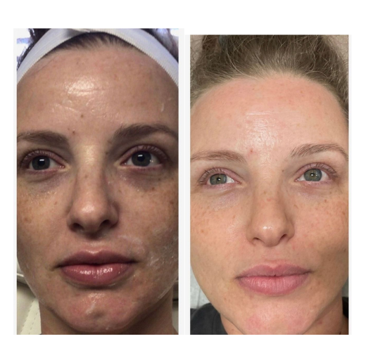 A before and after picture of a woman 's face