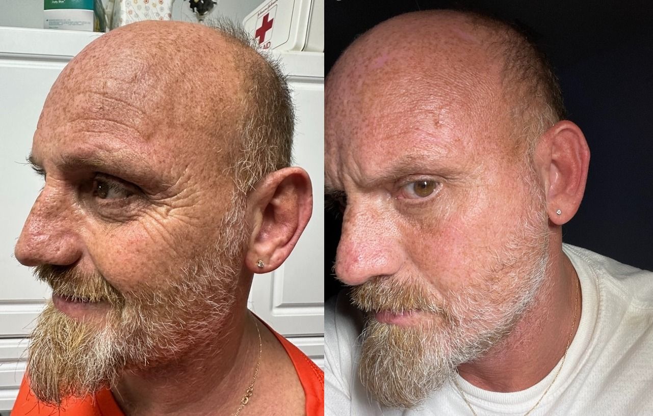 A man with a beard is shown before and after losing his hair.