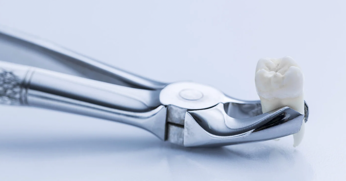 Top Signs You Need a Tooth Extraction and How to Prepare