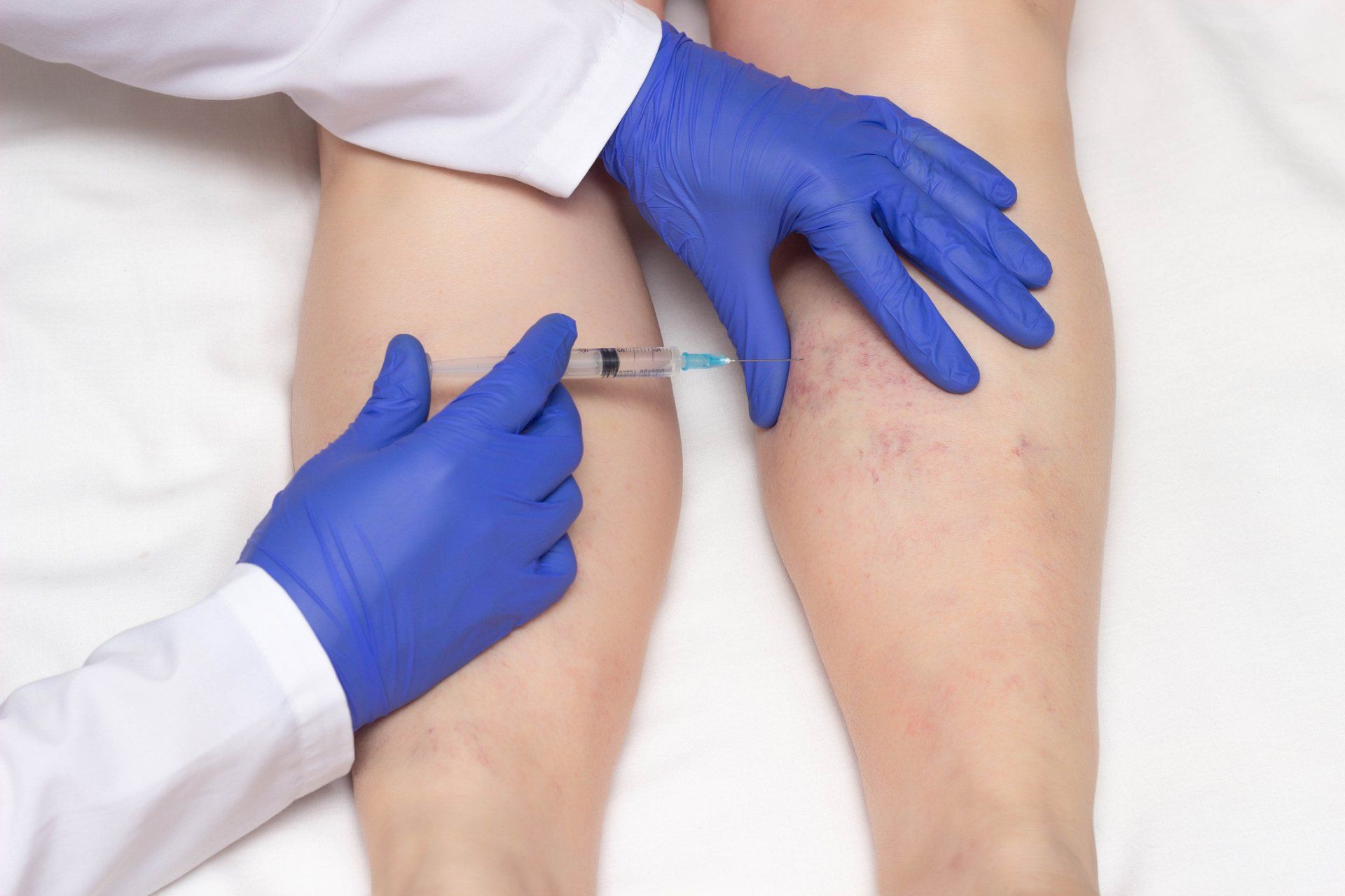 Medical professional in blue gloves injecting leg with a syringe; varicose veins visible.