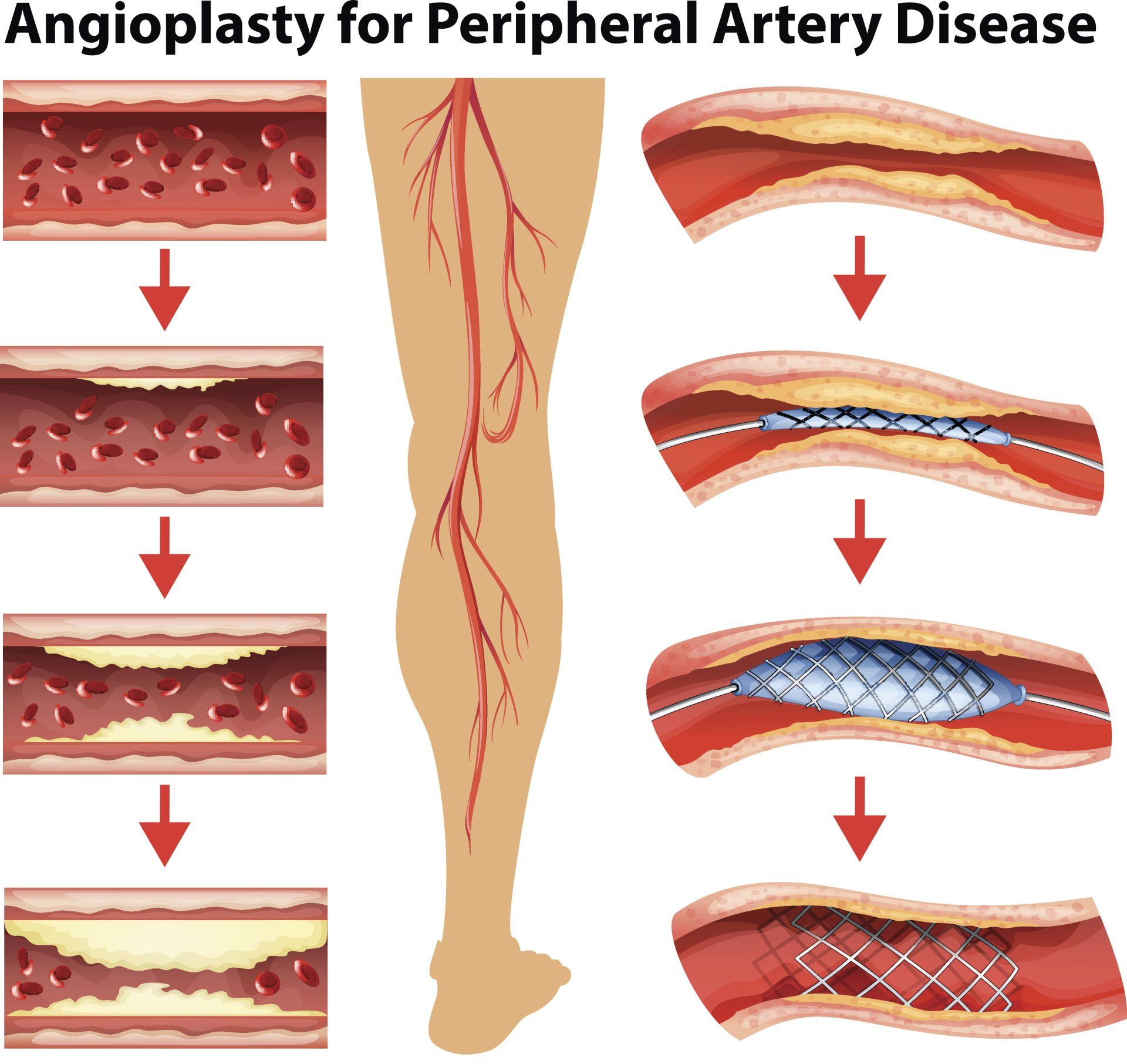 Diagram: Angioplasty for Peripheral Artery Disease. Shows a leg with blocked arteries being treated with a stent.
