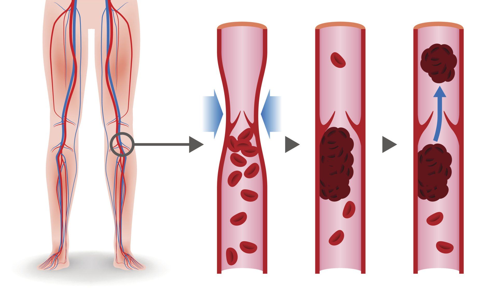 Diagram of blood clot formation in a leg vein; blood cells aggregate, forming a clot that blocks blood flow.
