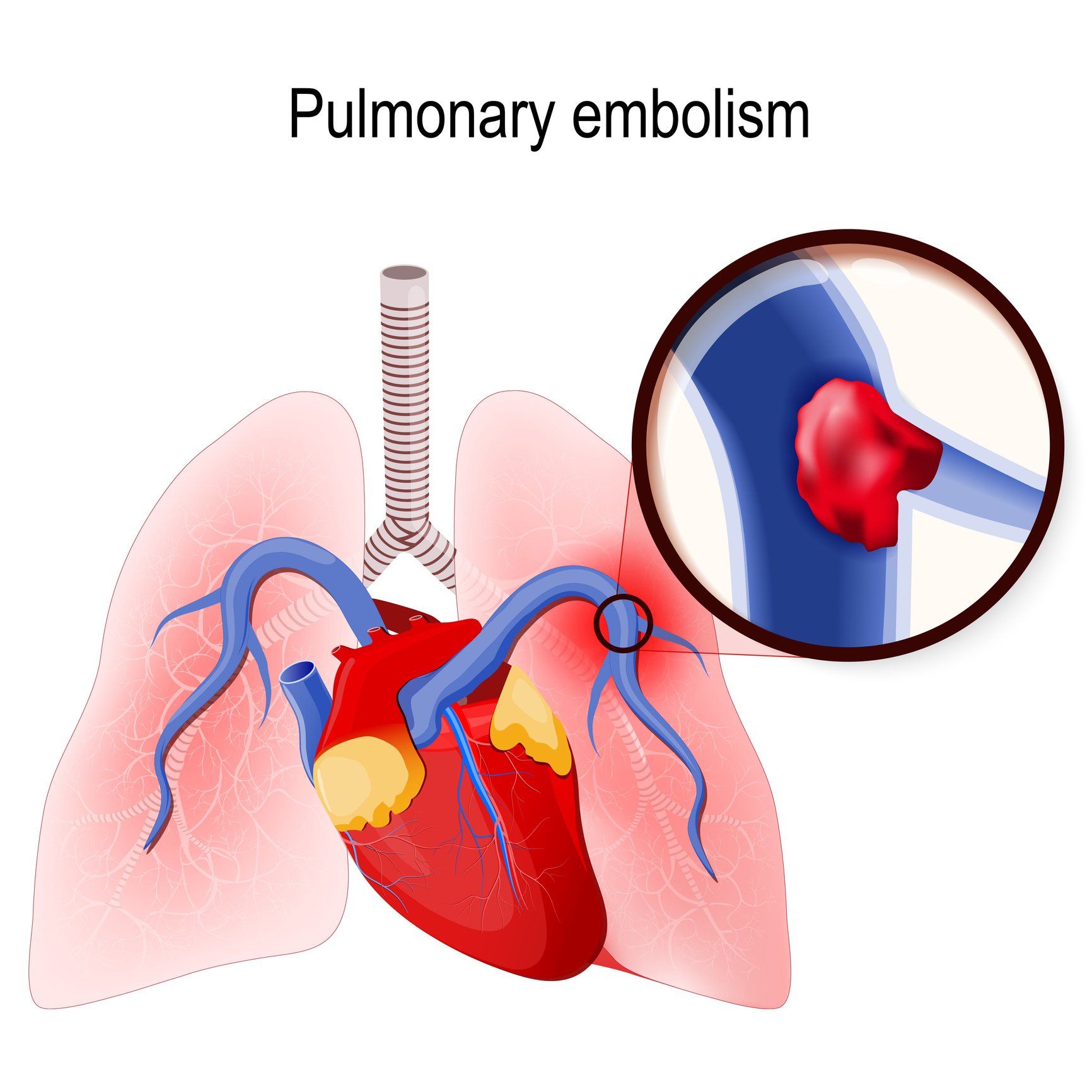 Illustration of a heart and lungs with a blood clot (red) blocking a pulmonary artery, depicting pulmonary embolism.