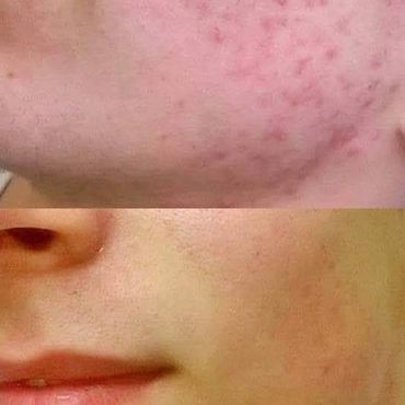 Laser Acne Treatment, Light and Dark Skin, Before and After