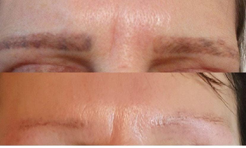 Eyebrows tattoo removal