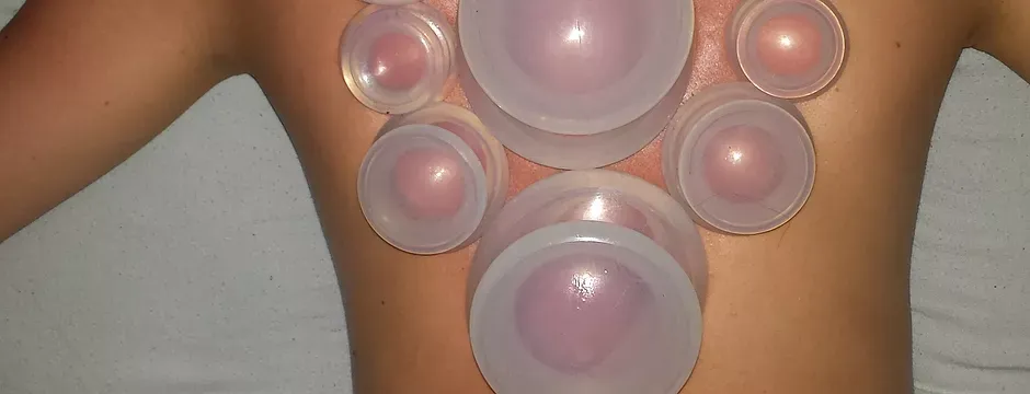 Benefits of Cupping Therapy