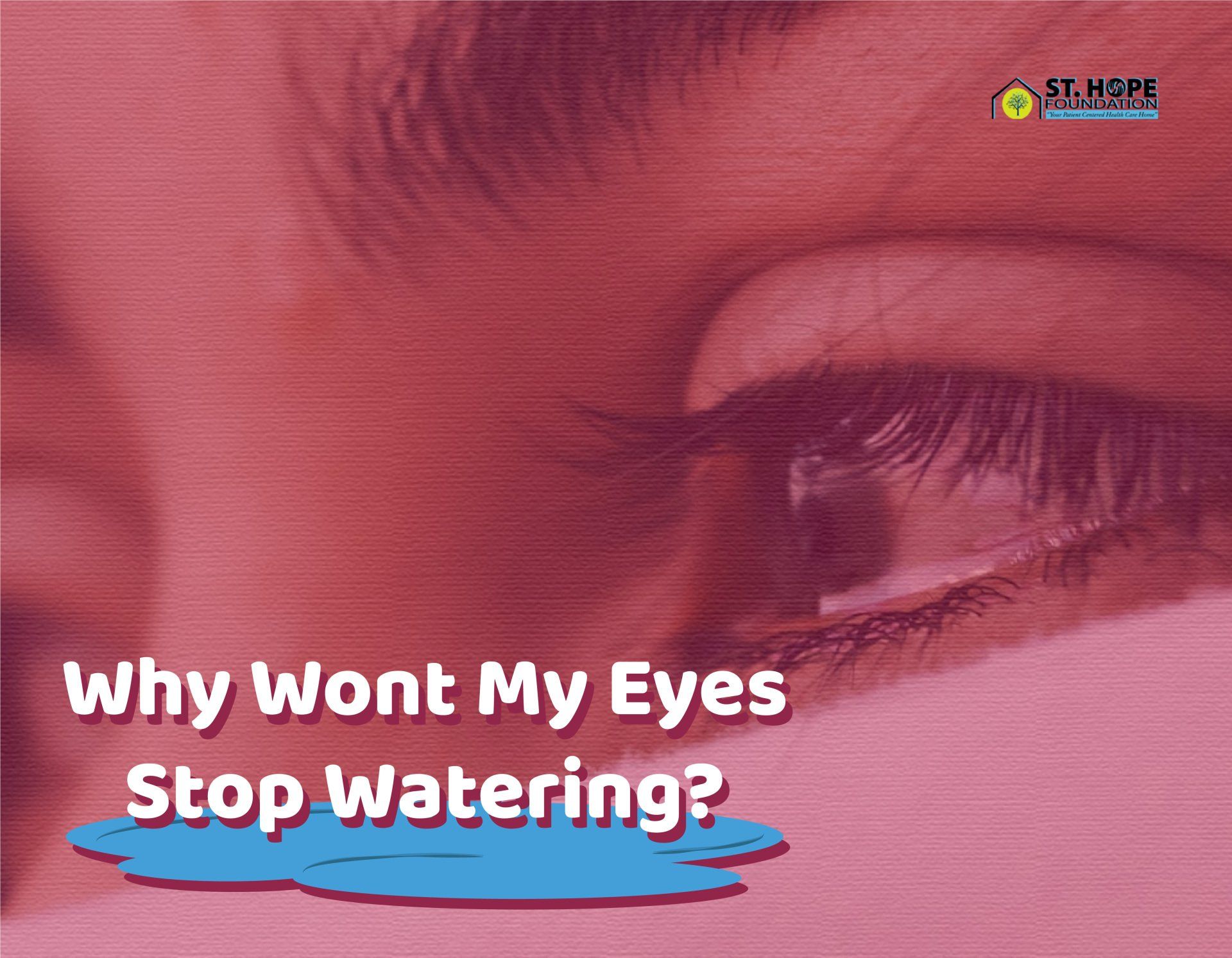 watery eyes