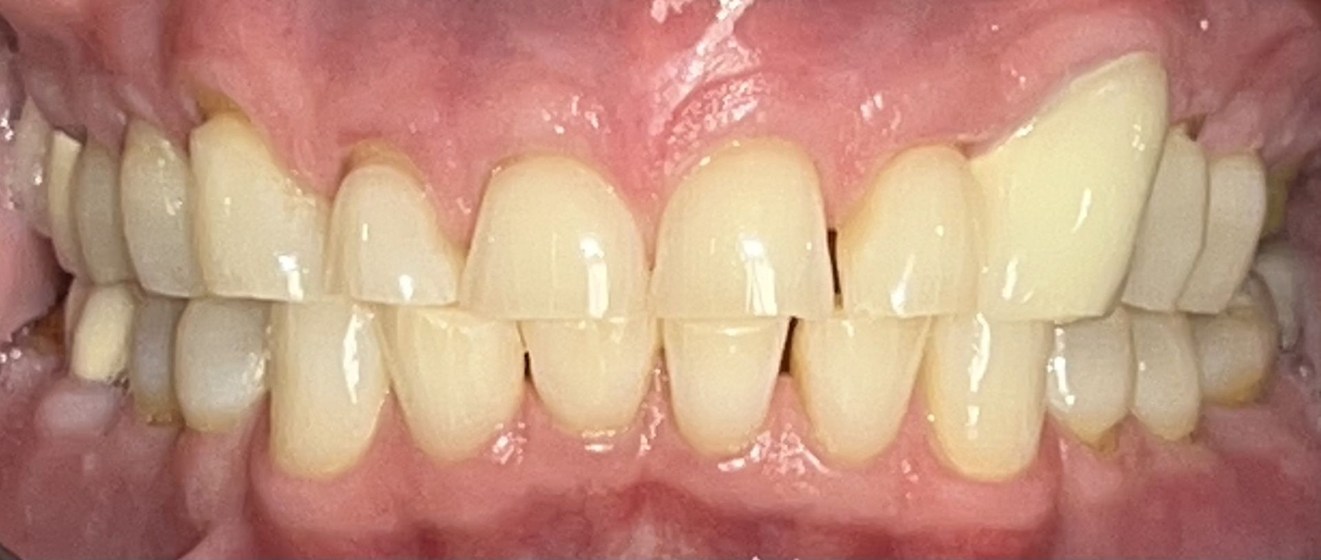 A close up of a person 's teeth and gums.