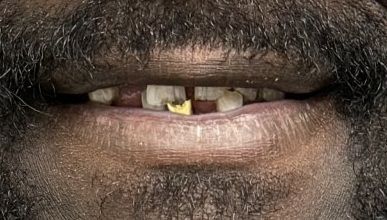 A close up of a man 's mouth with a beard and missing teeth.