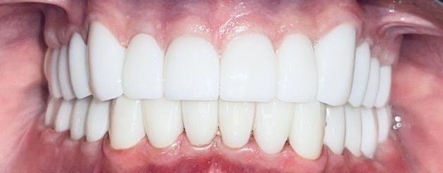 A close up of a person 's teeth with white teeth.