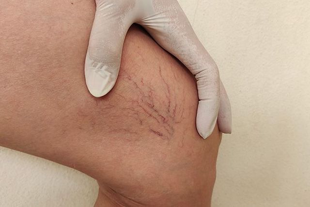 Spider Veins A Full Guide in 2023 - MD SPA