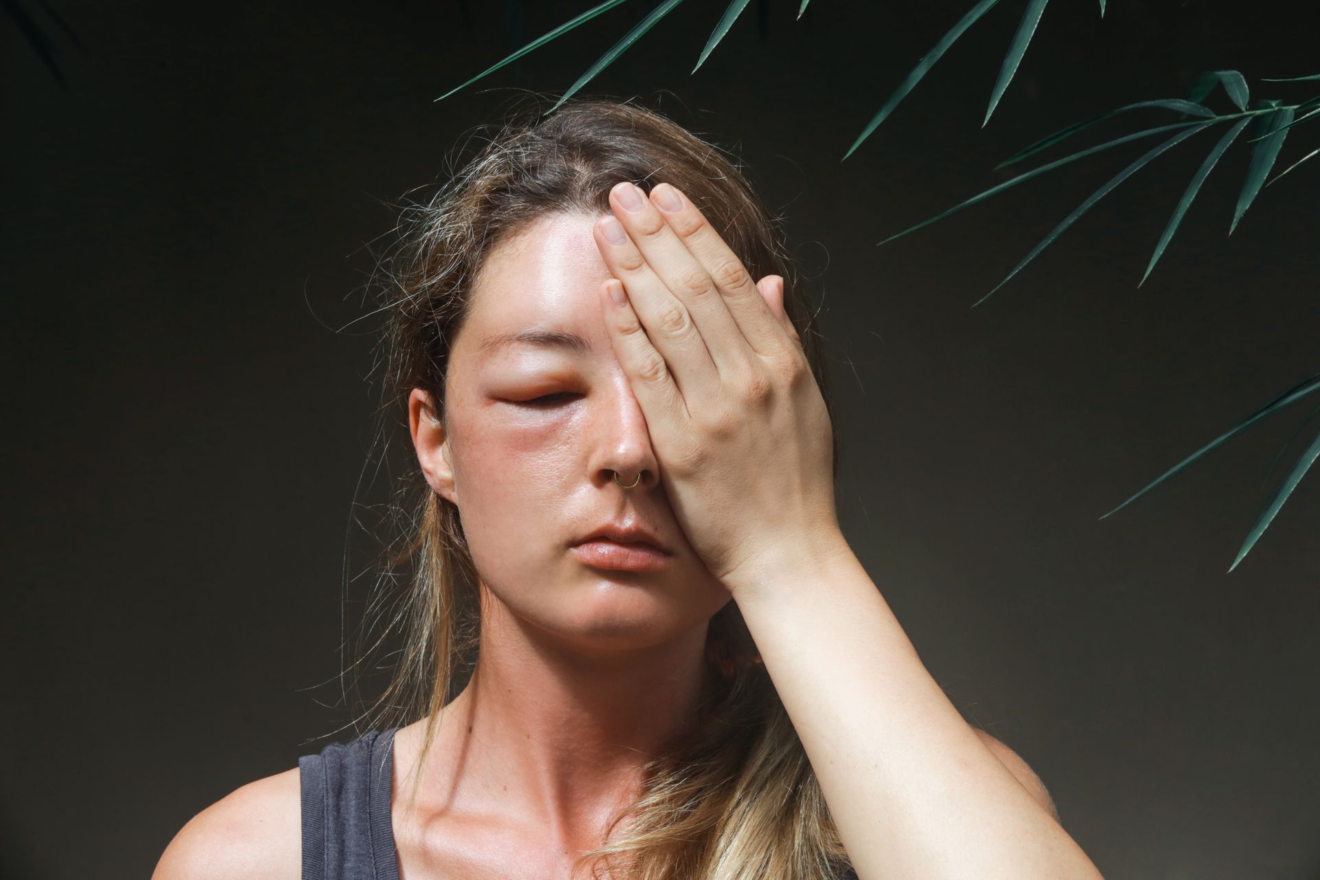 Woman with a swollen eye from a wasp sting