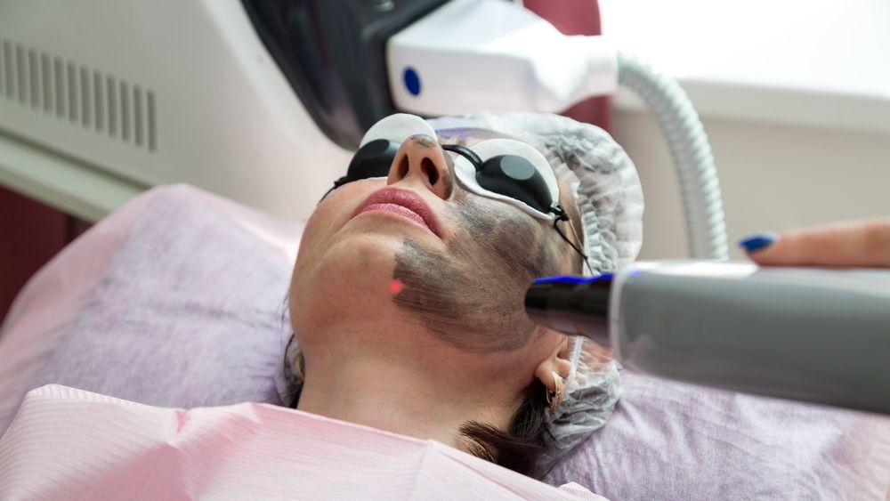 Woman undergoing laser skin treatment with carbon mask in a medical setting.