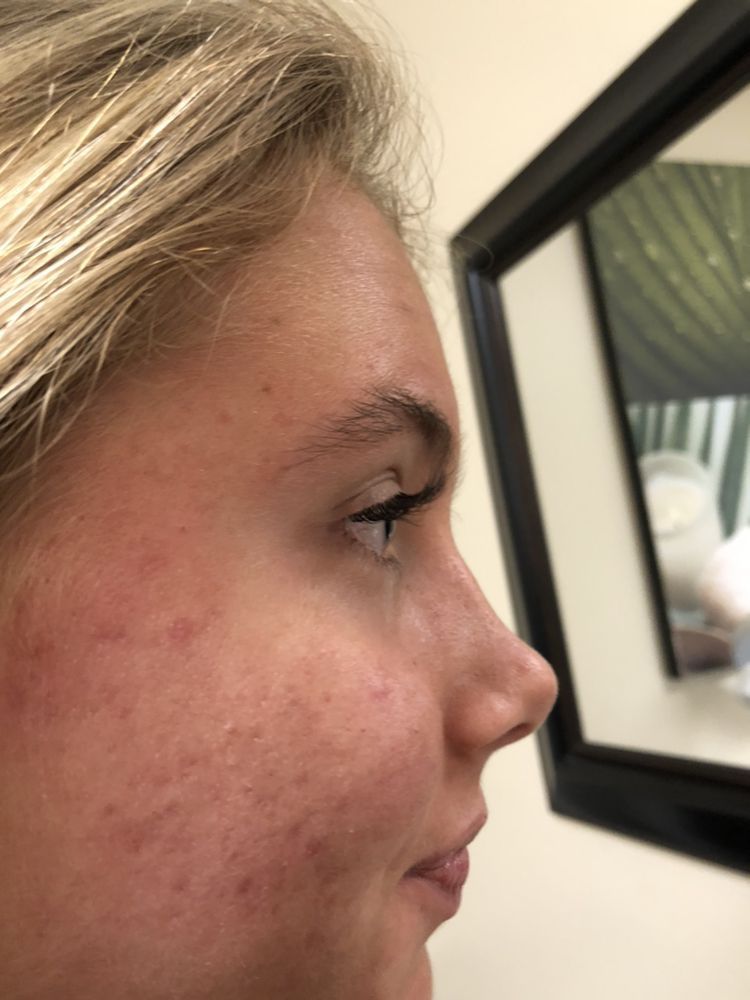 A side profile of a person’s face, showing textured skin with redness and minor blemishes, captured in soft indoor lighting.