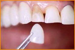 fascetta dentale applicata su denti