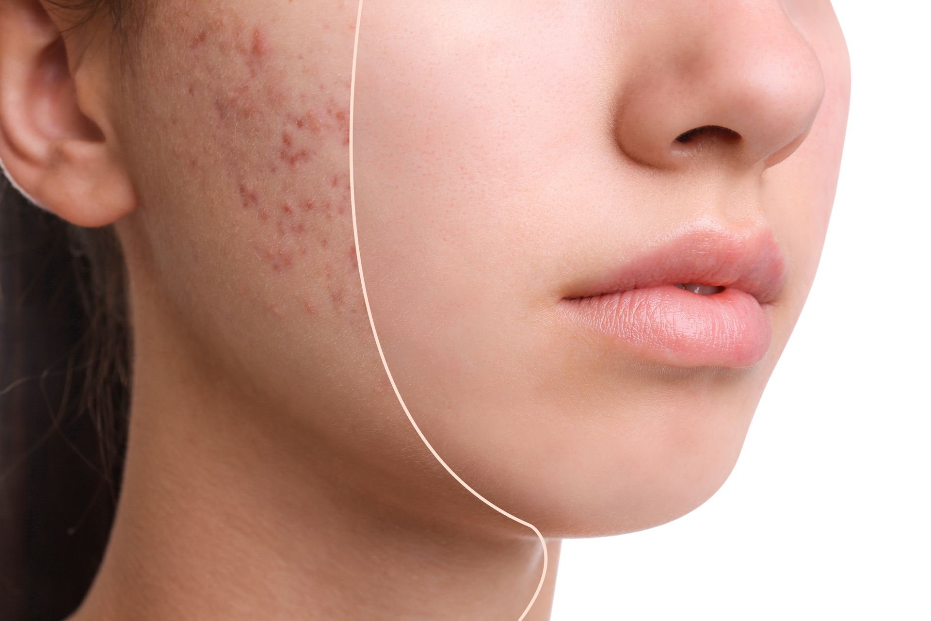 acne before after