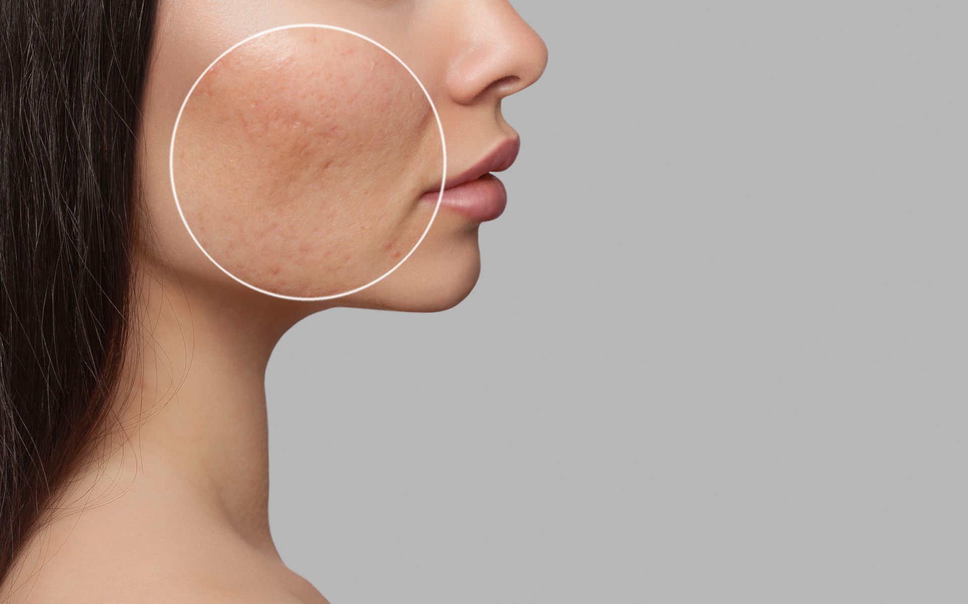 acne on woman's face