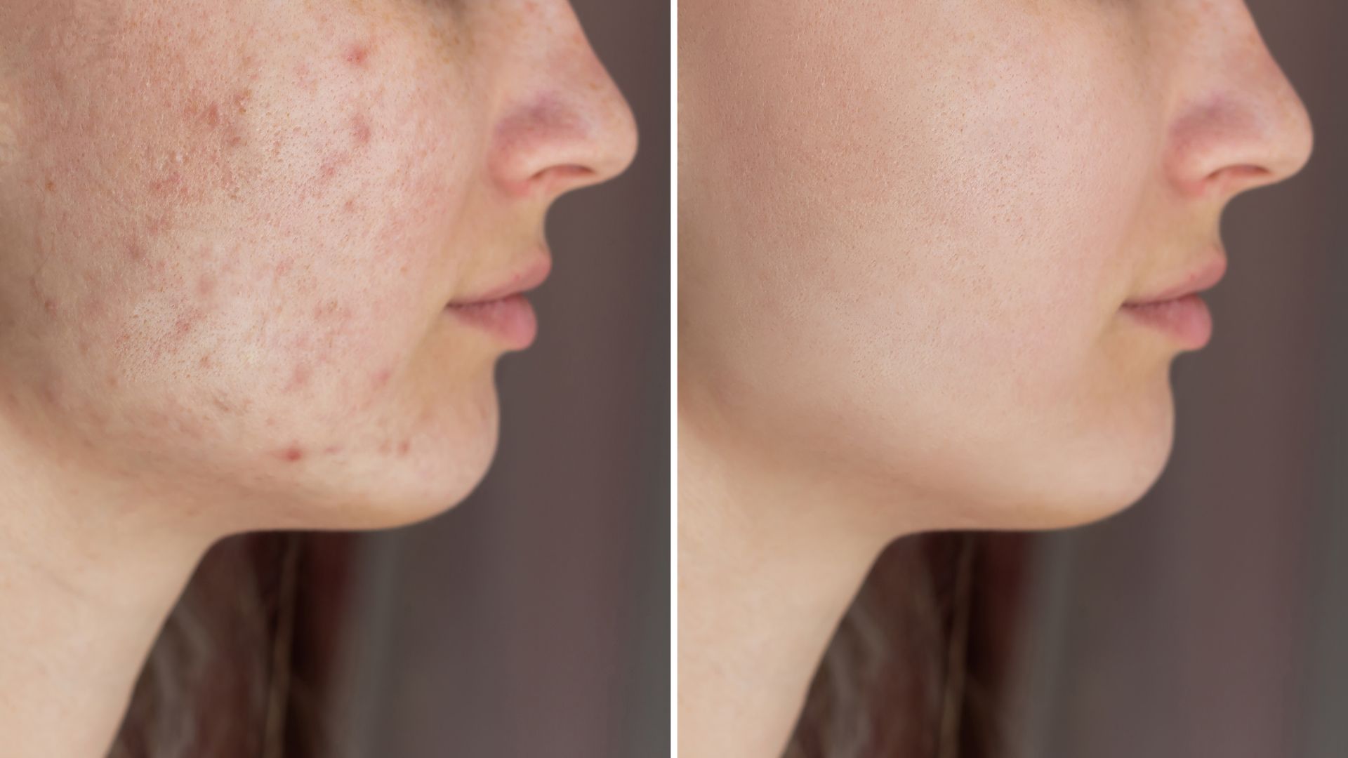 A before and after photo of a woman 's face with acne.