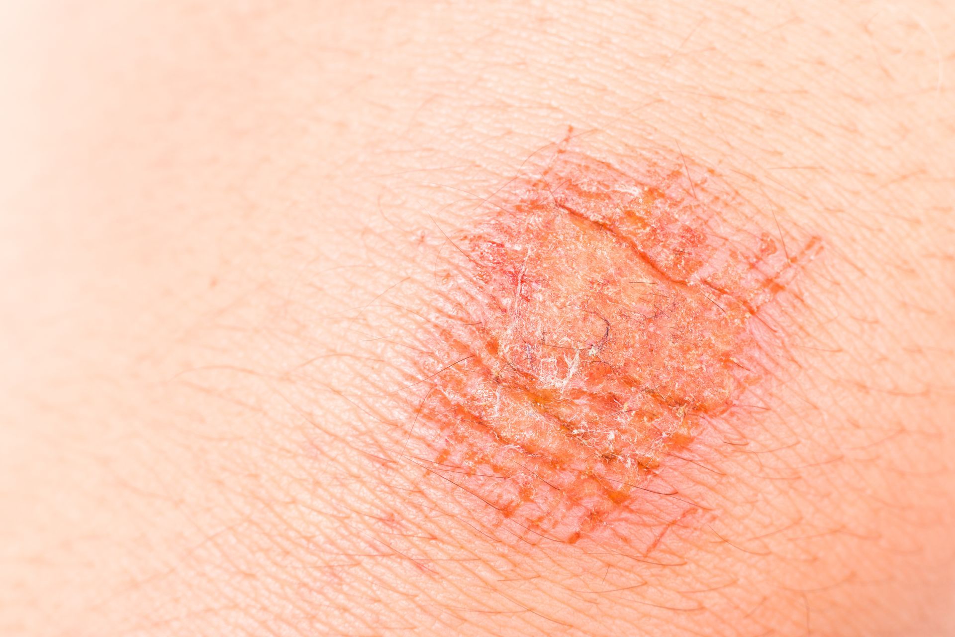 skin lesions