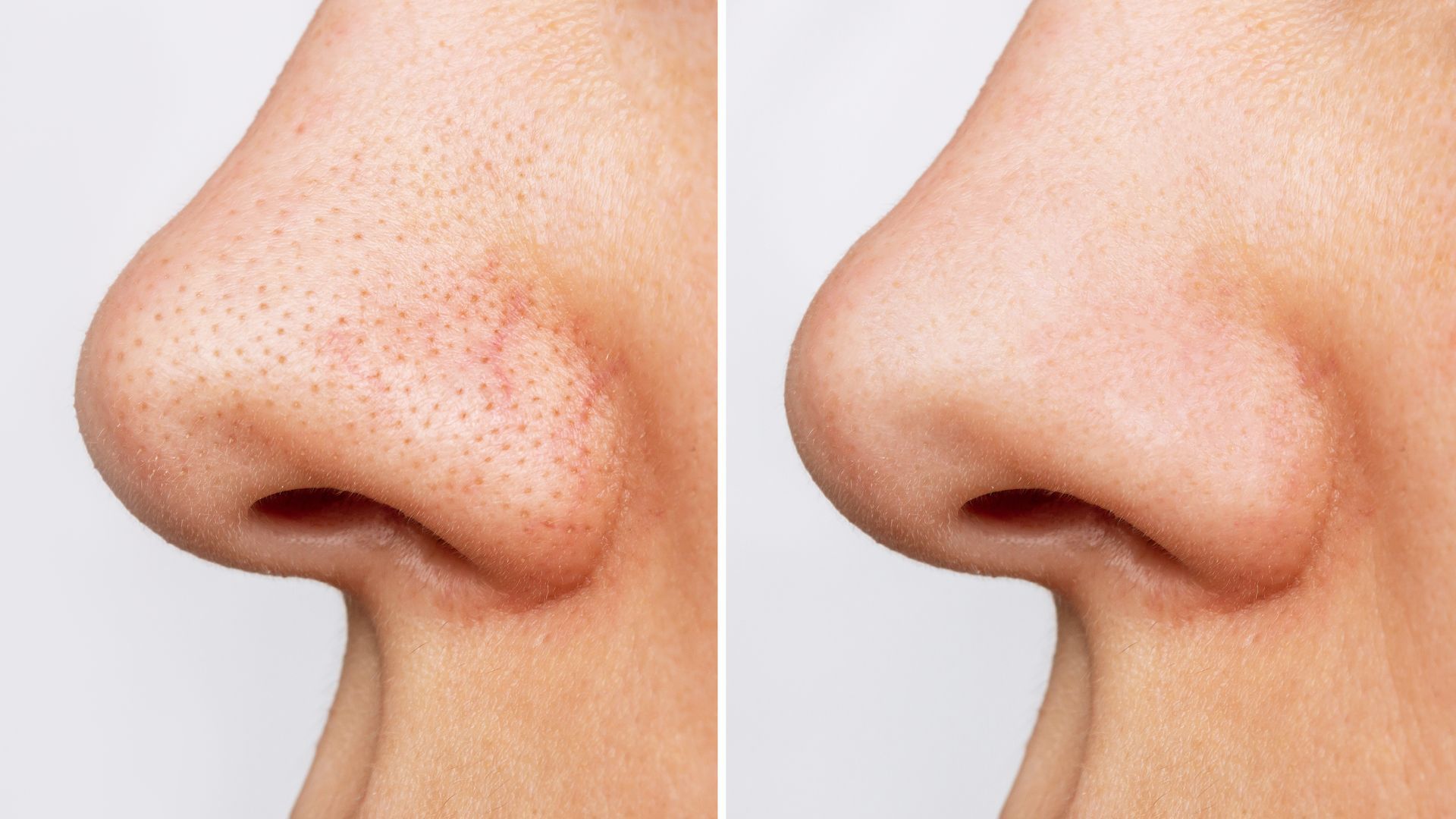 nose pore before after