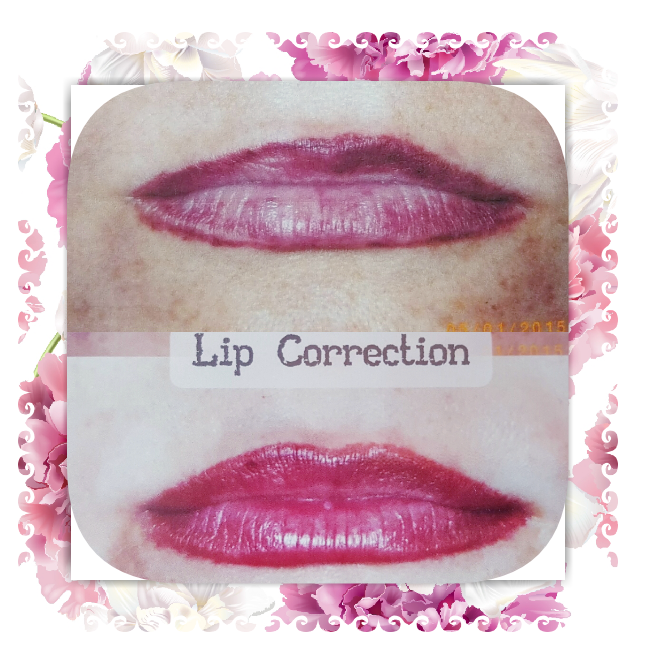 Before and after photos of lip correction; darker, thinner lips improved to fuller, brighter lips.