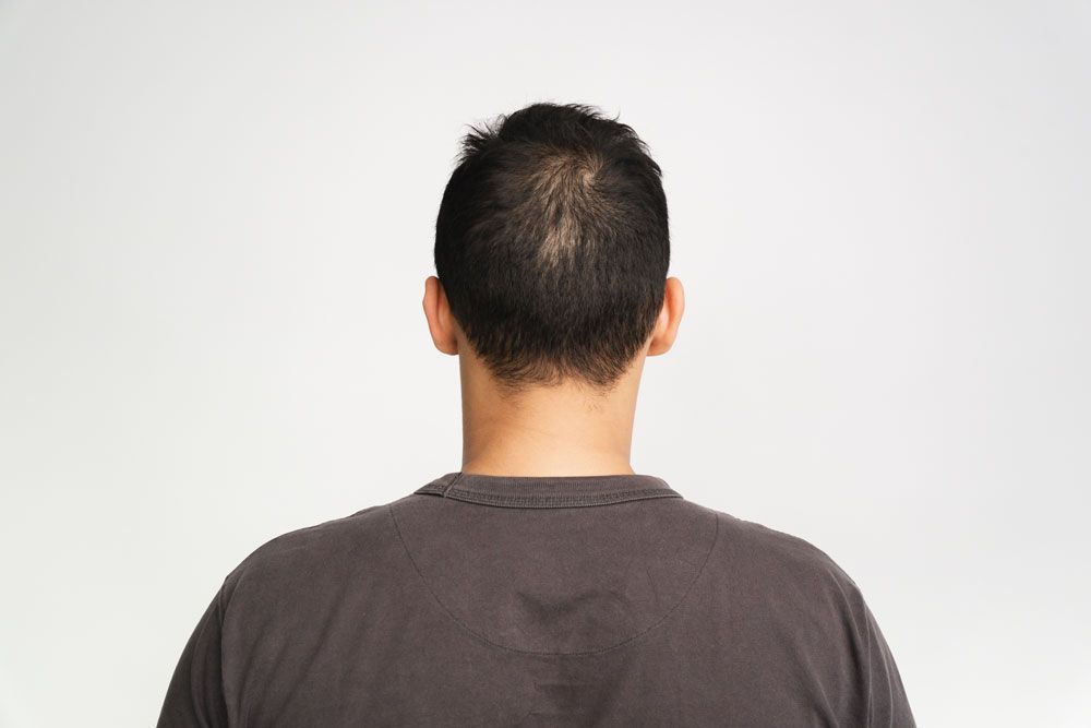 Man's head and shoulders from the back, showing thinning hair on the crown, wearing a gray shirt, against a white background.