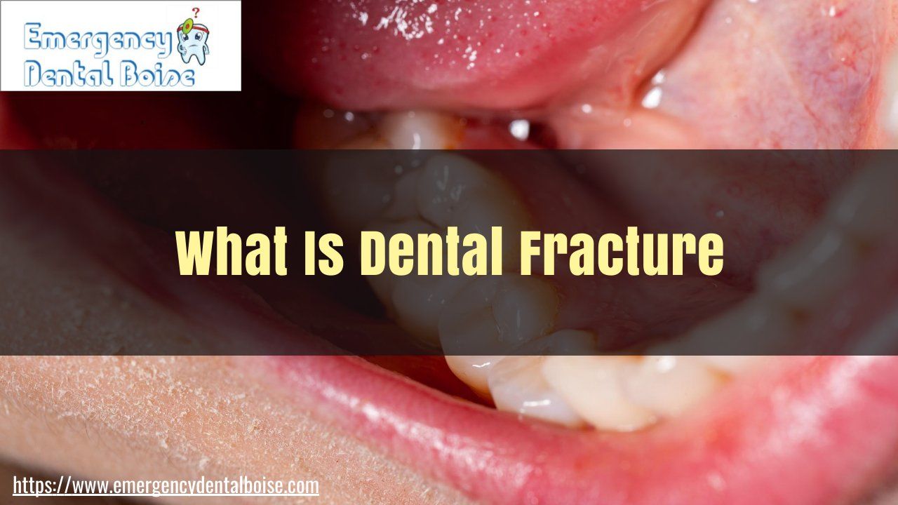 What Is a Dental Fracture?