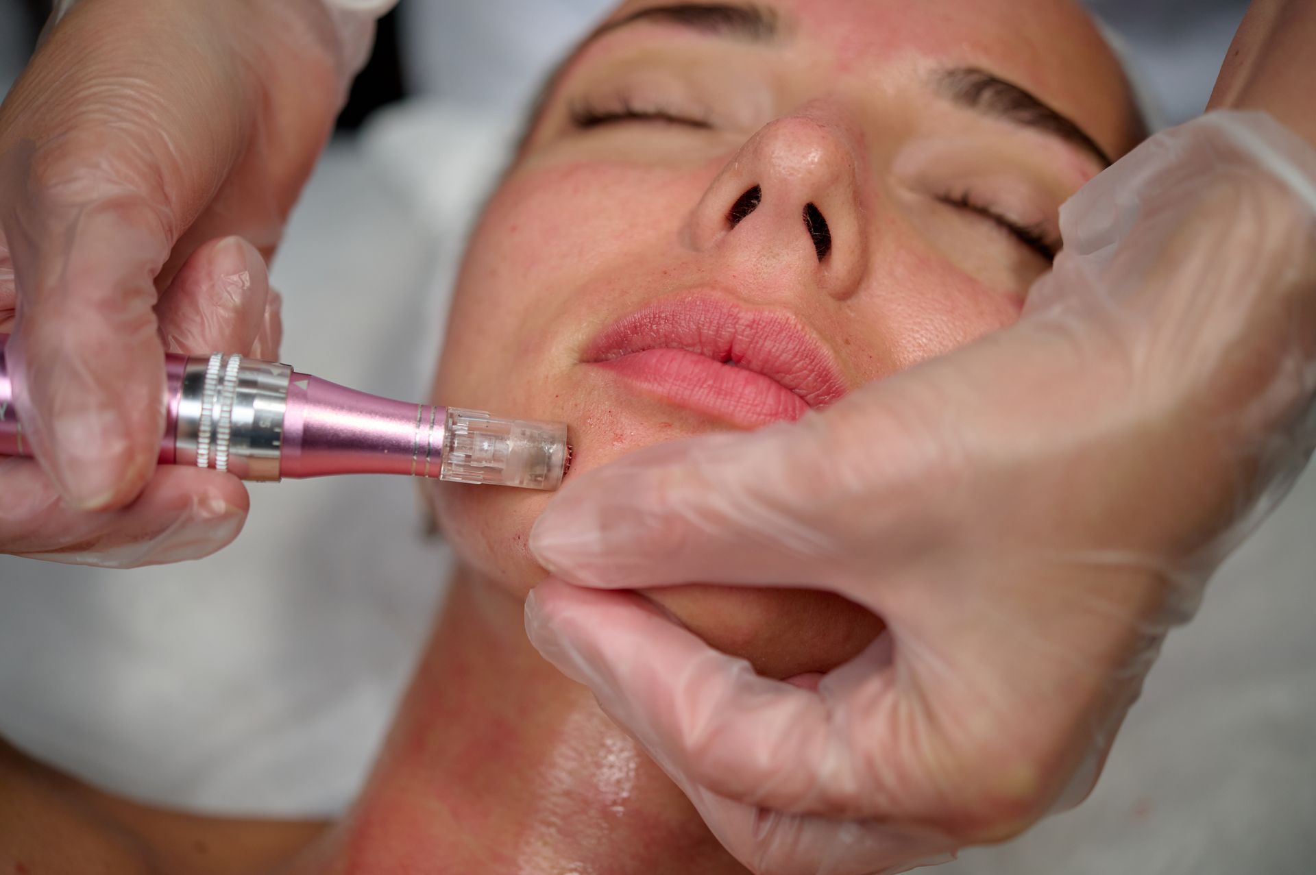 Person receiving a microneedling treatment on the face. Hands in gloves, pink device, close up.