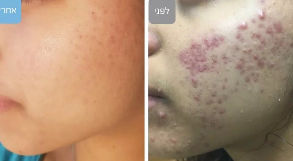 Axiom Medical Spa 1 Rated in Dallas specializing in Acne & Scar Treatment