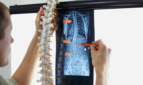 XRAY Result of Scoliosis — Sunnyside, WA — Yakima Valley Chiropractic Center